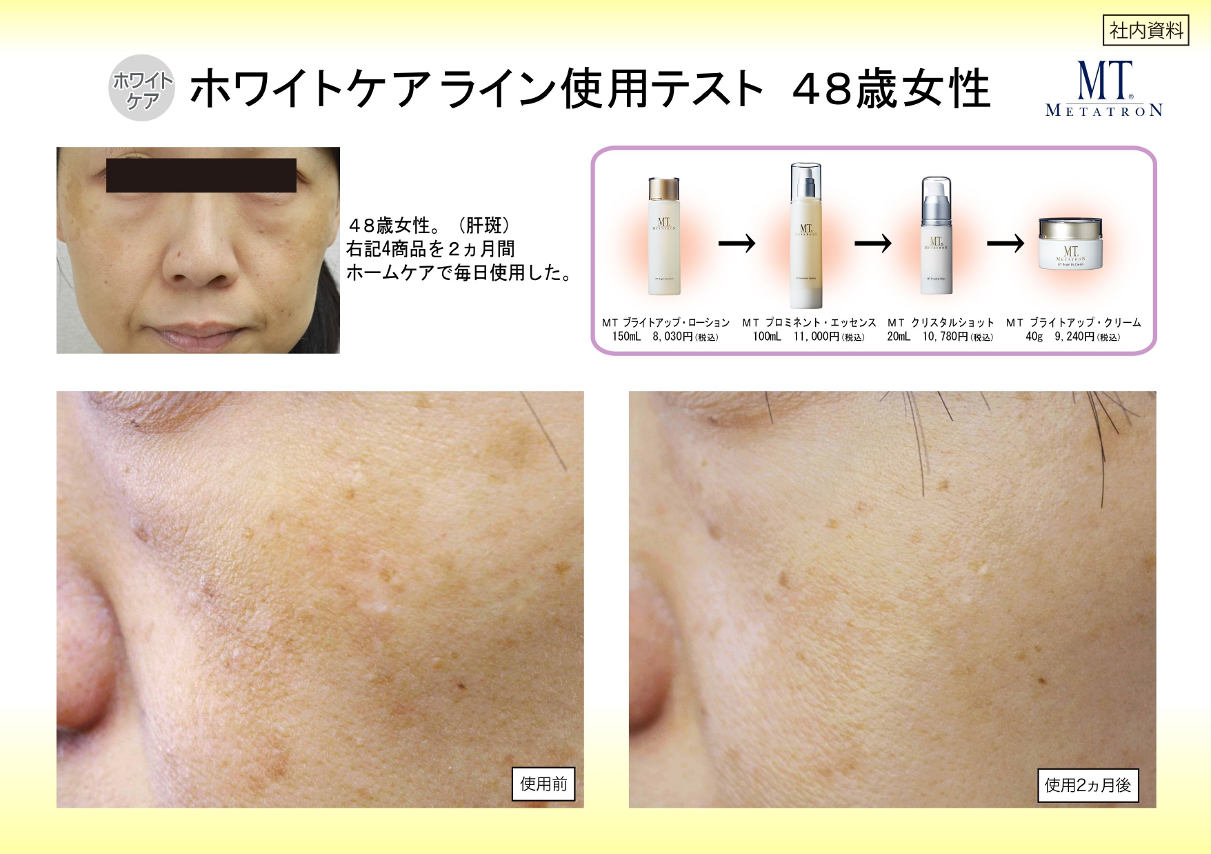 ホワイトケアライン使用テスト 48歳女性 2ヵ月後比較
